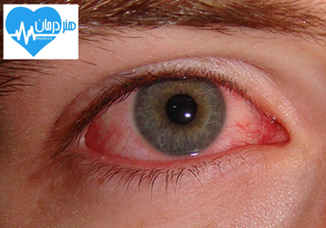 دلیل آبریزش چشم - درمان آبریزش چشم - مجاری اشک - ضربه به چشم - دکتر کجا برم؟