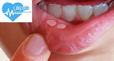 درمان آفت دهان و زبان1