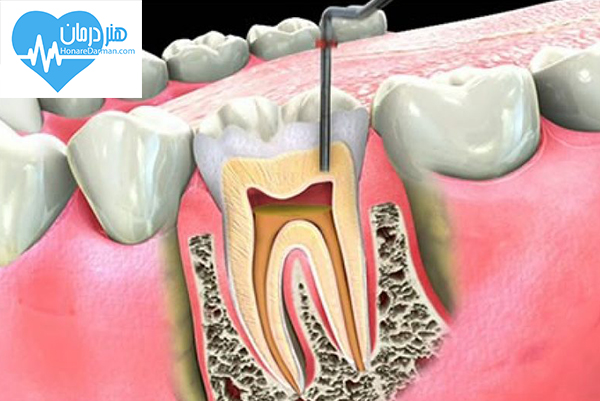 متخصص درمان ریشه (اندودنتیست)1