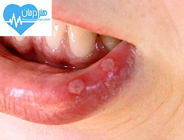 آفت دهان - درمان آفت دهان - آفت زبان - درمان آفت زبان - تبخال - کورتیکواستروئید - دلایل ایجاد آفت دهان