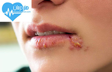 تبخال - درمان تبخال - علائم تبخال - ویروس herpes simplex - تبخال تناسلی - درمان تبخال تناسلی - عوارض تبخال تناسلی