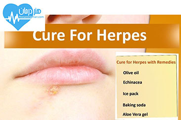 تبخال - درمان تبخال - علائم تبخال - ویروس herpes simplex - تبخال تناسلی - درمان تبخال تناسلی - عوارض تبخال تناسلی