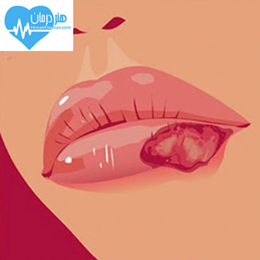 تبخال - درمان تبخال - علائم تبخال - ویروس herpes simplex - تبخال تناسلی - درمان تبخال تناسلی - عوارض تبخال تناسلی