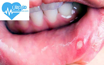 آفت دهان - درمان آفت دهان - آفت زبان - درمان آفت زبان - تبخال - کورتیکواستروئید - دلایل ایجاد آفت دهان
