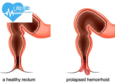 بواسیر - درمان بواسیر - هموروئید - درمان هموروئید - سوفورا - جراحی هموروئید - جراحی بواسیر 