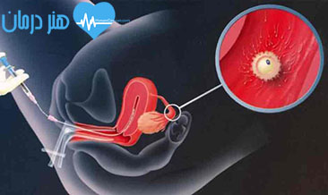 IUI  - تزریق اسپرم - Cyclogest - آزمایش حاملگی