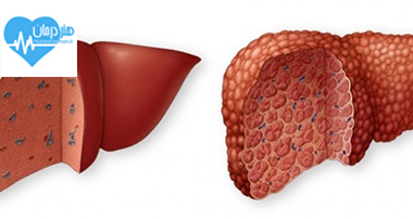 نزدیکان فرد مبتلا به سیروز - سرطان کبد - سیروز