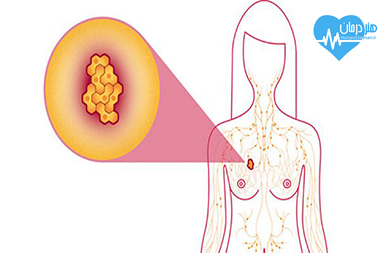 بثورات پستان , سوزش پستان , قرمزی پستان , سوزش پوست پستان , قرمزی پوست پستان , کهیر , تاول , خارش پستان , ورم پستان , درمان التهاب پستان , دکتر خوب , پزشک خوب , بهترین پزشک
