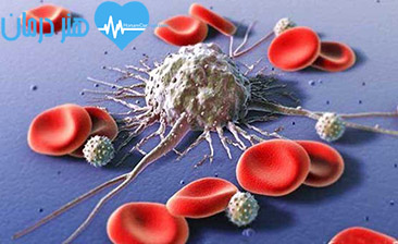 خون مخفی - سرطان کولون - پولیپ روده - آزمایش غربالگری - خون در مدفوع