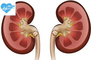 علایم شایع سنگ کلیه- درمان سنگ کلیه- سنگ کلیه- دکتر خوب- پزشک خوب- دکتر متخصص- پزشک متخصص